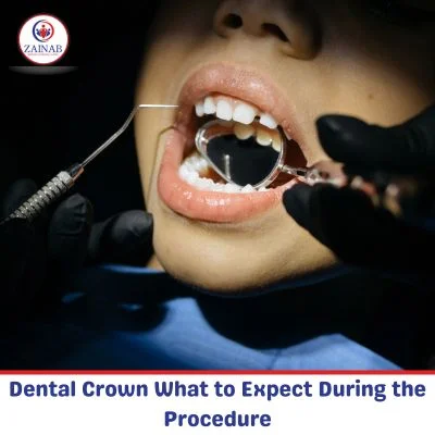Dental Crown What to Expect During the Procedure