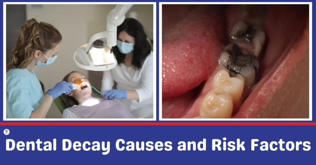 Dental Decay Causes and Risks Factors