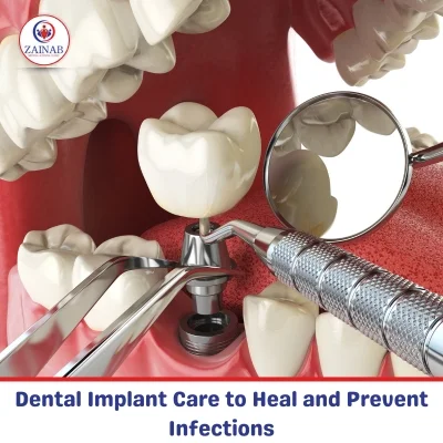 Dental Implant Care to Heal and Prevent Infections