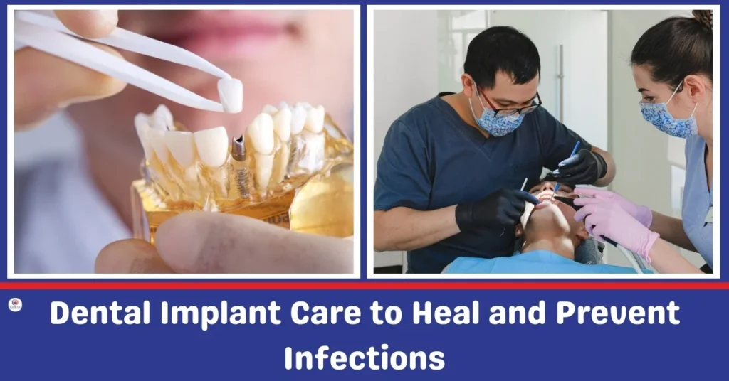 Dental Implant Care to Heal and Prevents Infections