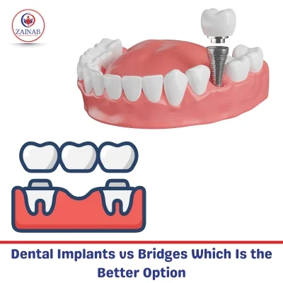 Dental Implants vs Bridges Which Is the Better Option