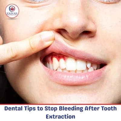 Dental Tips to Stop Bleeding After Tooth Extraction